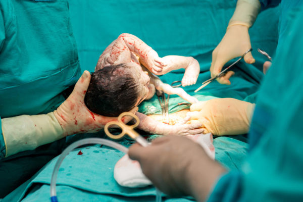 الولادة القيصرية بدون ألم 2