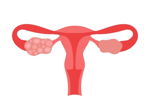 Fibroids