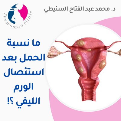 نسبة الحمل بعد استئصال الورم الليفي