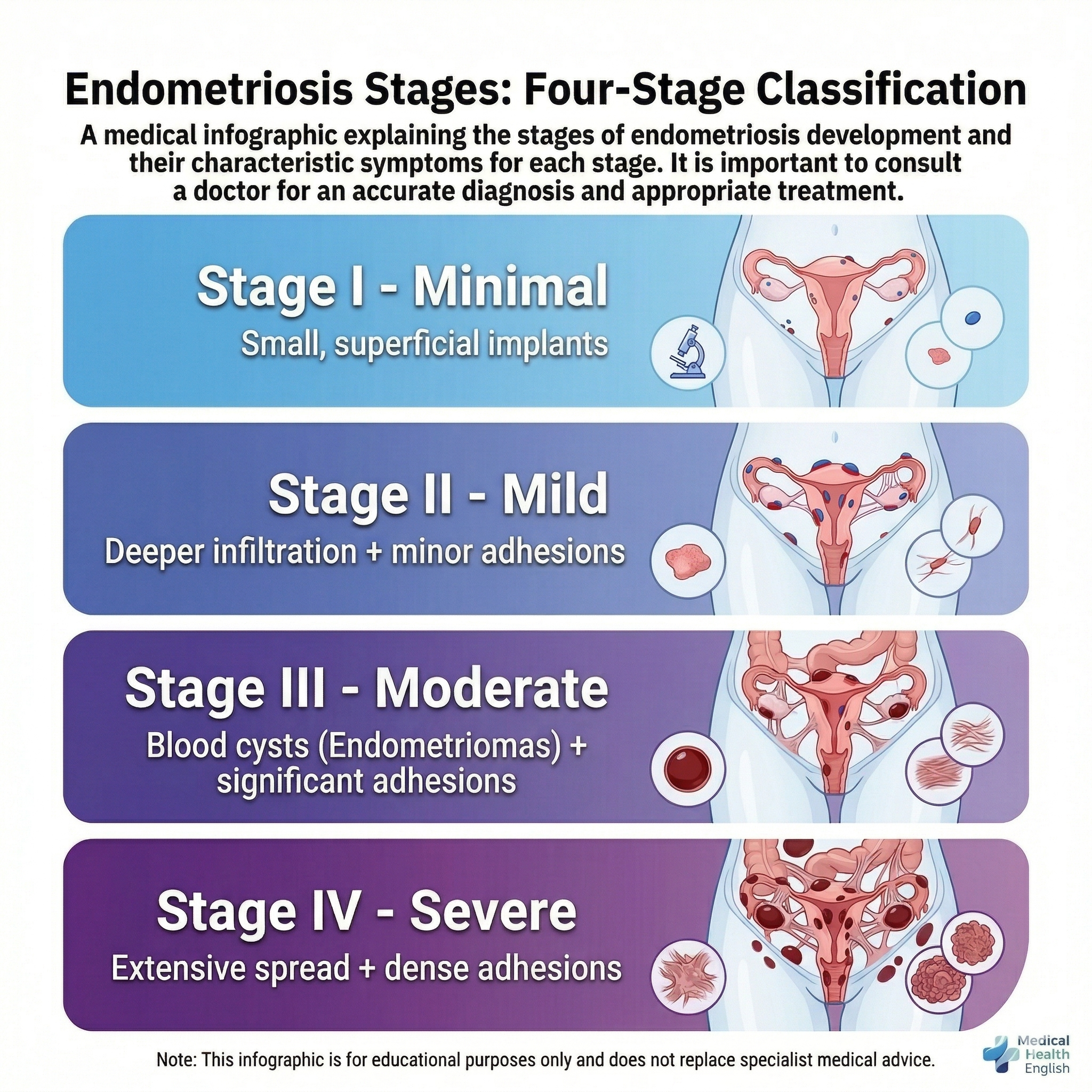 The Four Stages of Endometriosis