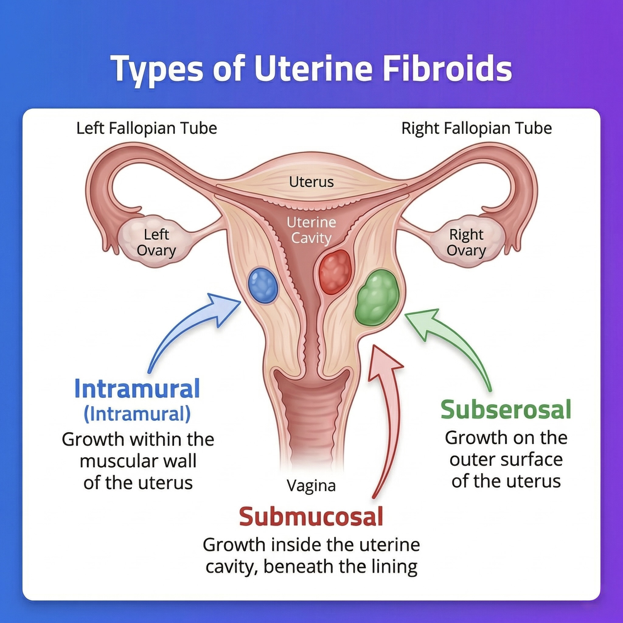 Types of Uterine Fibroids by Location